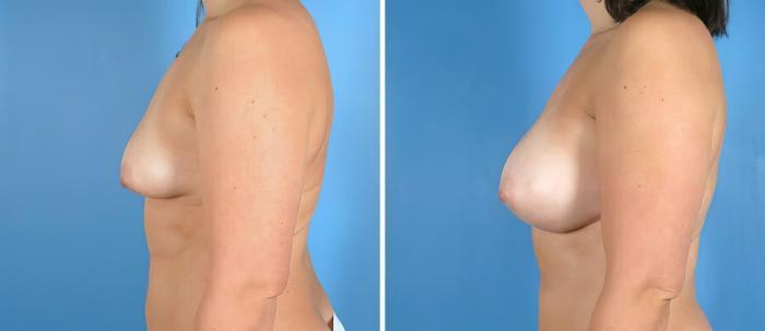 Breast Augmentation Before & After Case 19866