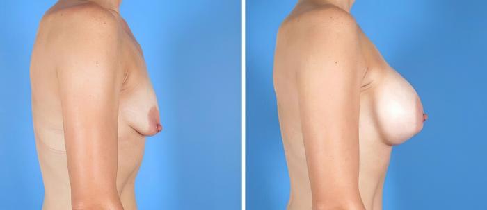 Breast Augmentation Before & After Case 19872