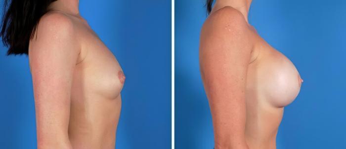 Breast Augmentation Before & After Case 22924