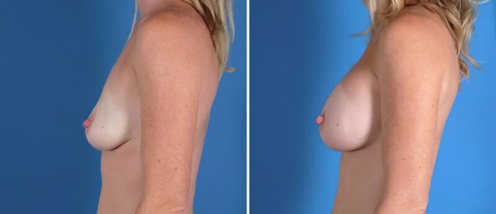 Breast Augmentation Before & After Case 22943
