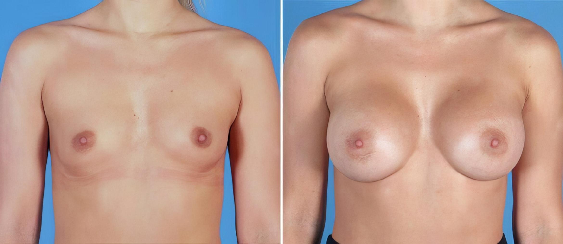 Breast Augmentation Before & After Case 24876