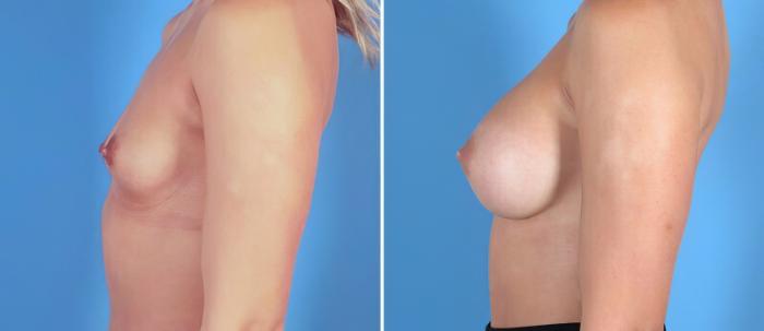 Breast Augmentation Before & After Case 24876