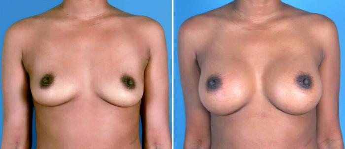 Breast Augmentation Before & After Case 24879