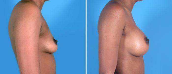 Breast Augmentation Before & After Case 24879