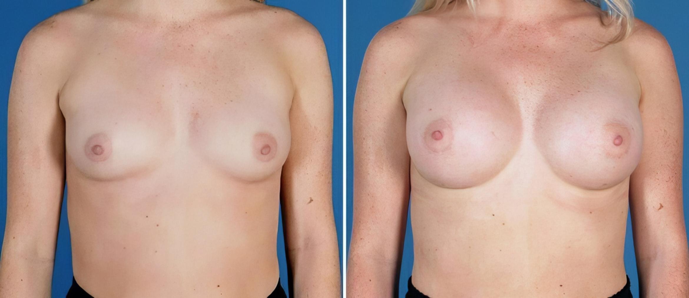 Breast Augmentation Before & After Case 24882