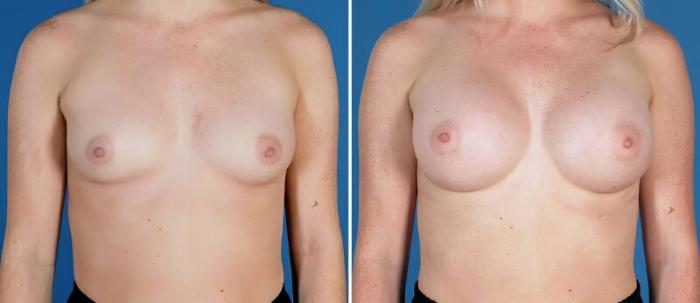 Breast Augmentation Before & After Case 24882