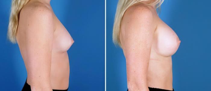 Breast Augmentation Before & After Case 24882