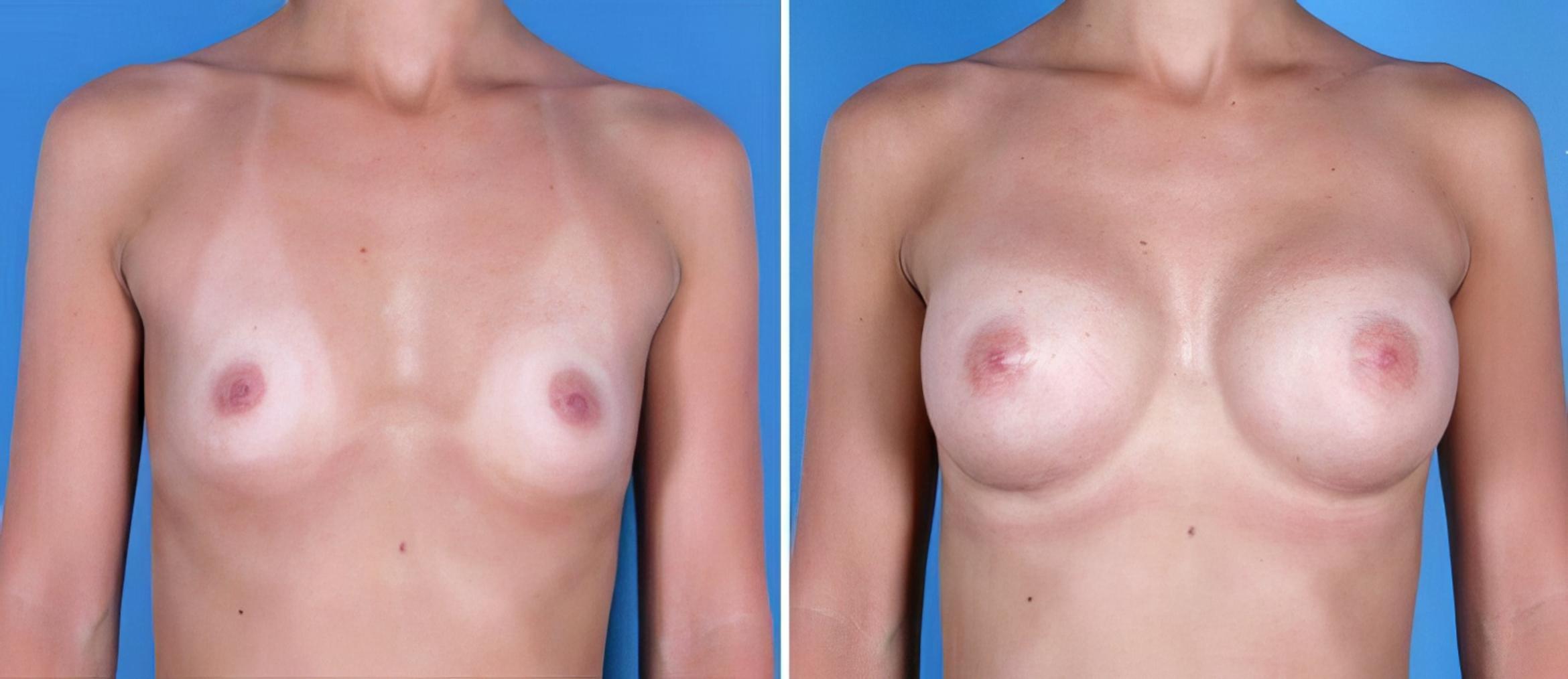 Breast Augmentation Before & After Case 24885