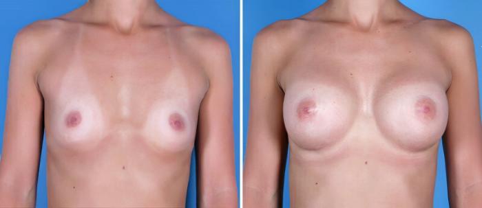 Breast Augmentation Before & After Case 24885
