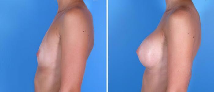 Breast Augmentation Before & After Case 24885