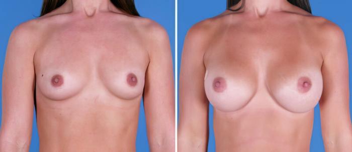 Breast Augmentation Before & After Case 24888
