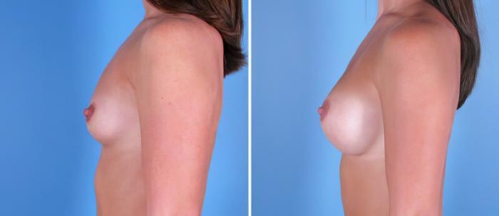 Breast Augmentation Before & After Case 24888