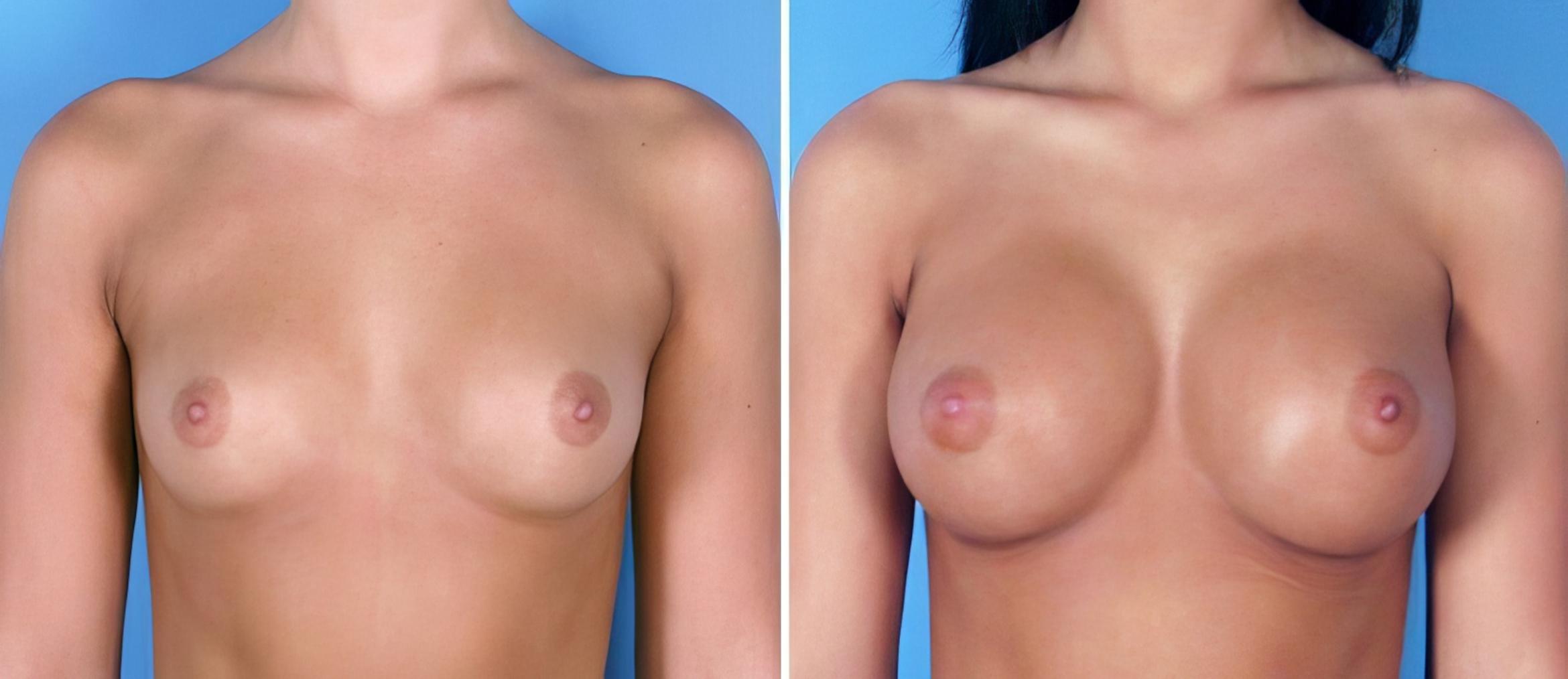 Breast Augmentation Before & After Case 24891
