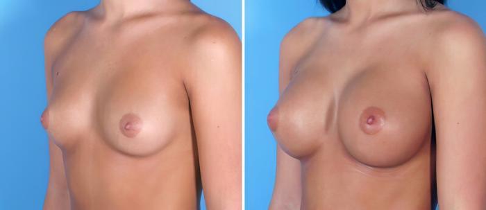 Breast Augmentation Before & After Case 24891