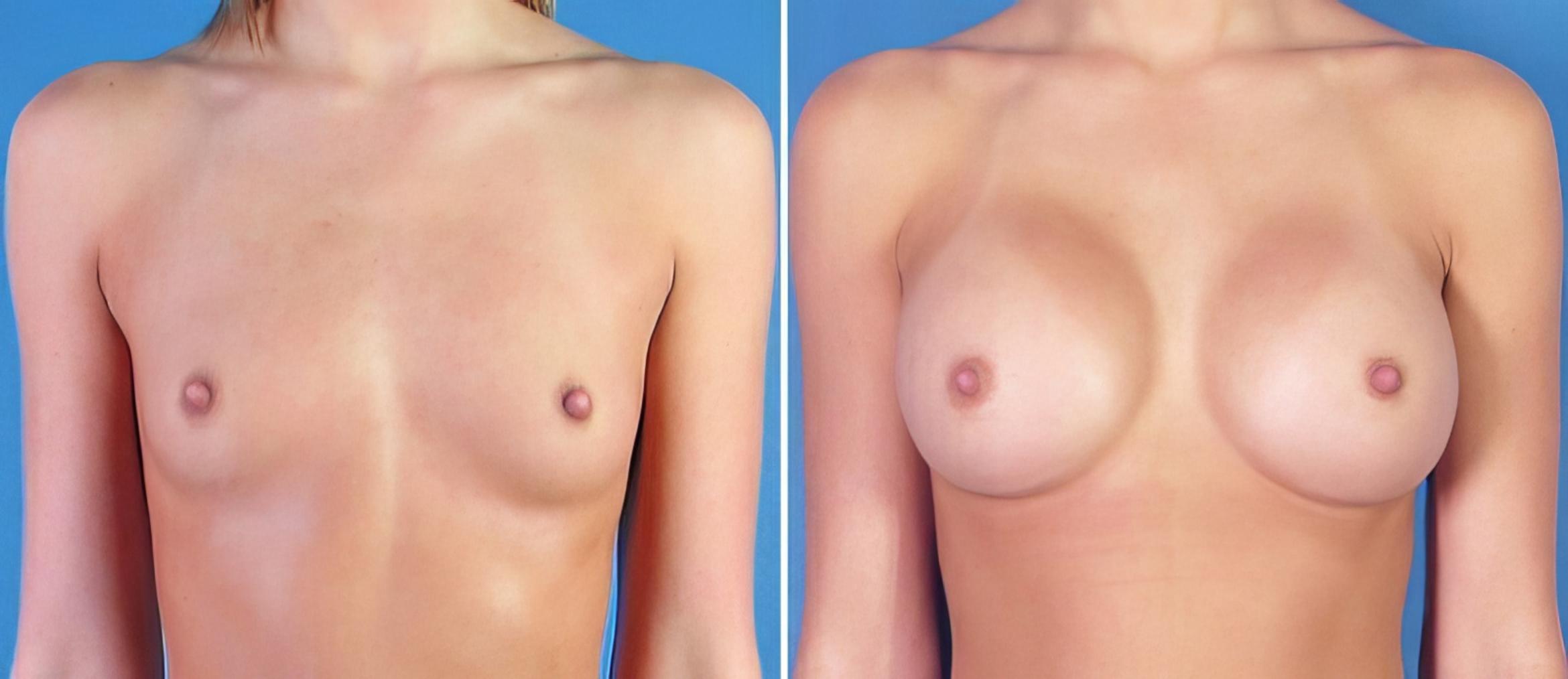 Breast Augmentation Before & After Case 24894