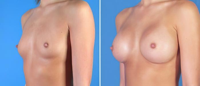 Breast Augmentation Before & After Case 24894