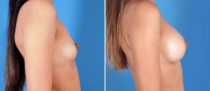 Breast Augmentation Before & After Case 24897
