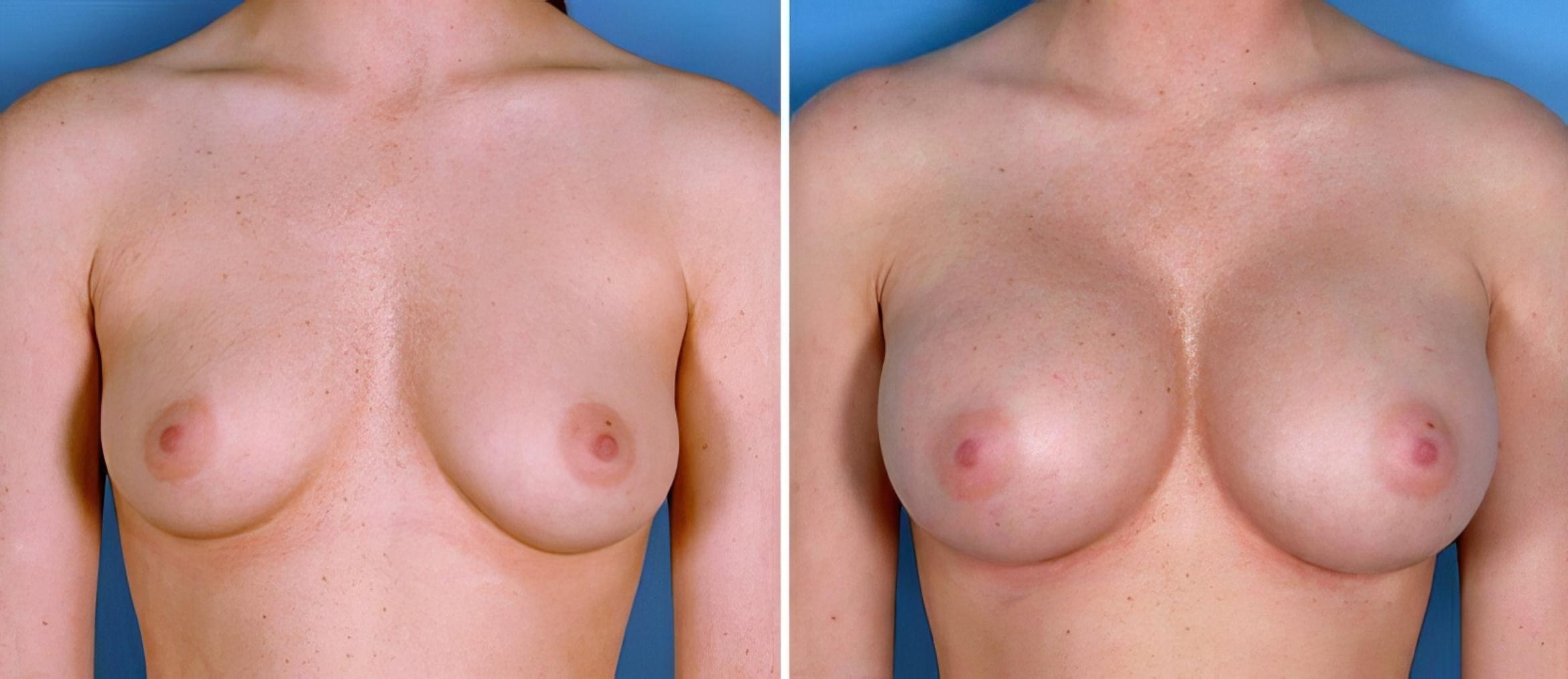 Breast Augmentation Before & After Case 24918