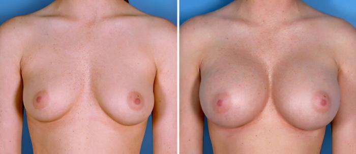 Breast Augmentation Before & After Case 24918