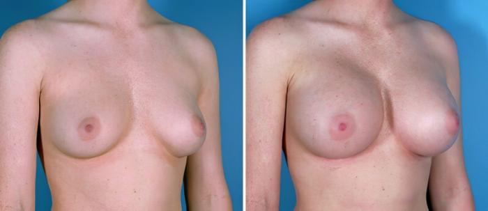 Breast Augmentation Before & After Case 24918