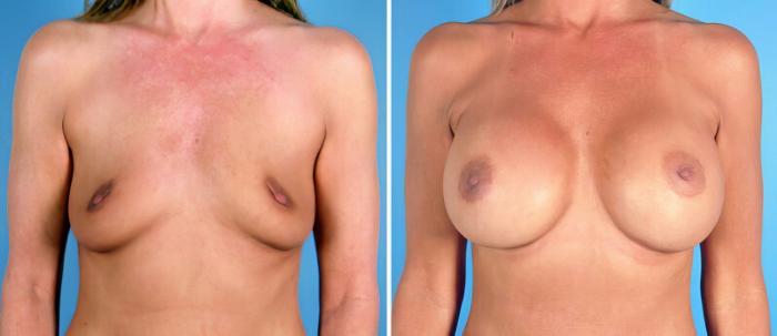 Breast Augmentation Before & After Case 24921