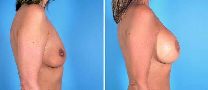 Breast Augmentation Before & After Case 24921