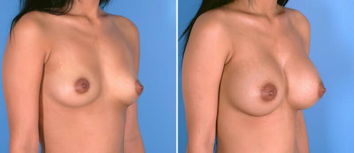 Breast Augmentation Before & After Case 24924