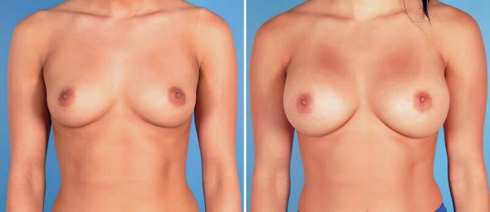 Breast Augmentation Before & After Case 24927
