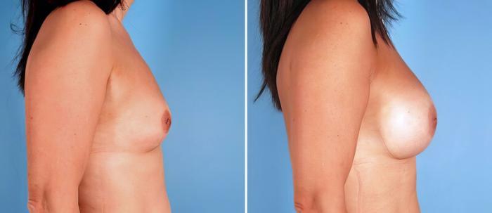 Breast Augmentation Before & After Case 24936