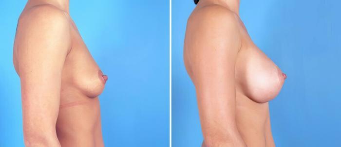 Breast Augmentation Before & After Case 25181