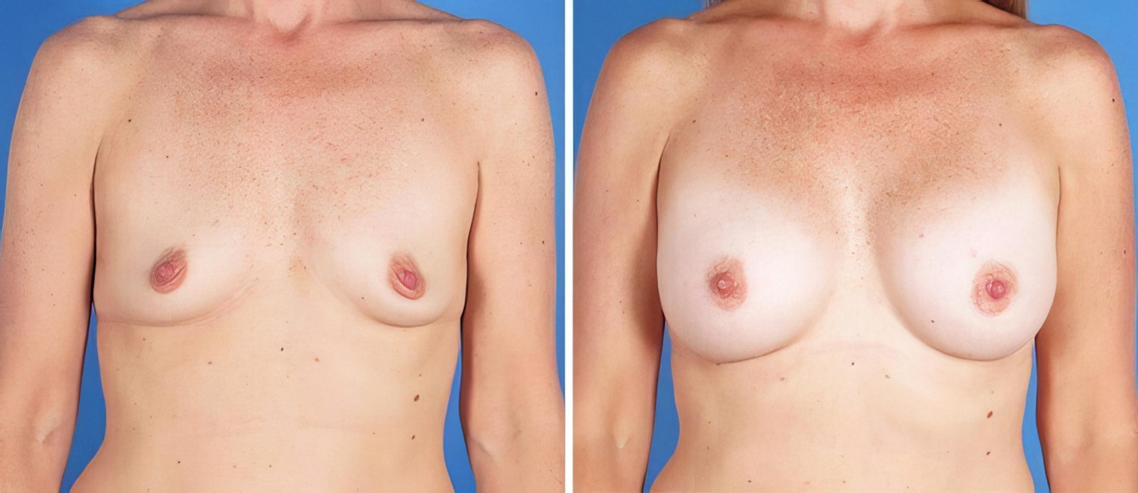Breast Augmentation Before & After Case 25191