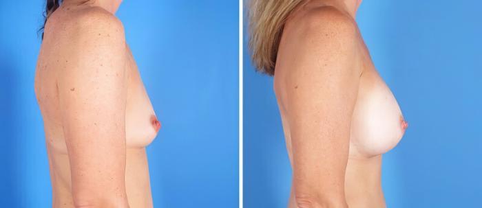 Breast Augmentation Before & After Case 25191