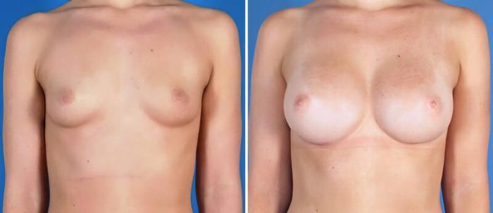 Breast Augmentation Before & After Case 25196