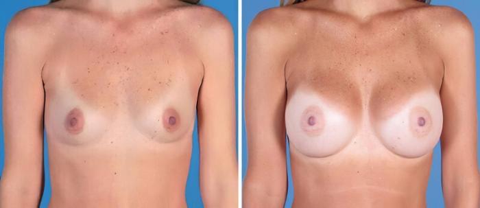 Breast Augmentation Before & After Case 25200