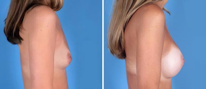 Breast Augmentation Before & After Case 25200
