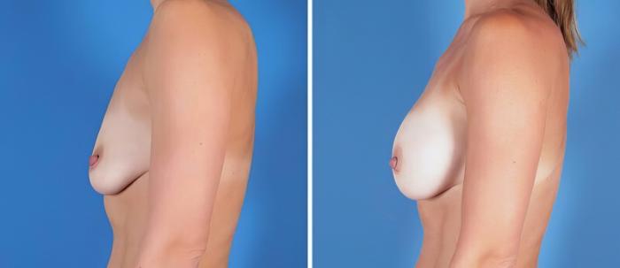 Breast Augmentation Before & After Case 25203