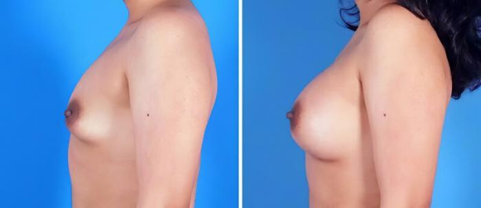 Breast Augmentation Before & After Case 25206