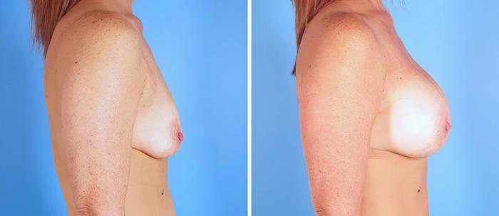 Breast Augmentation Before & After Case 25209