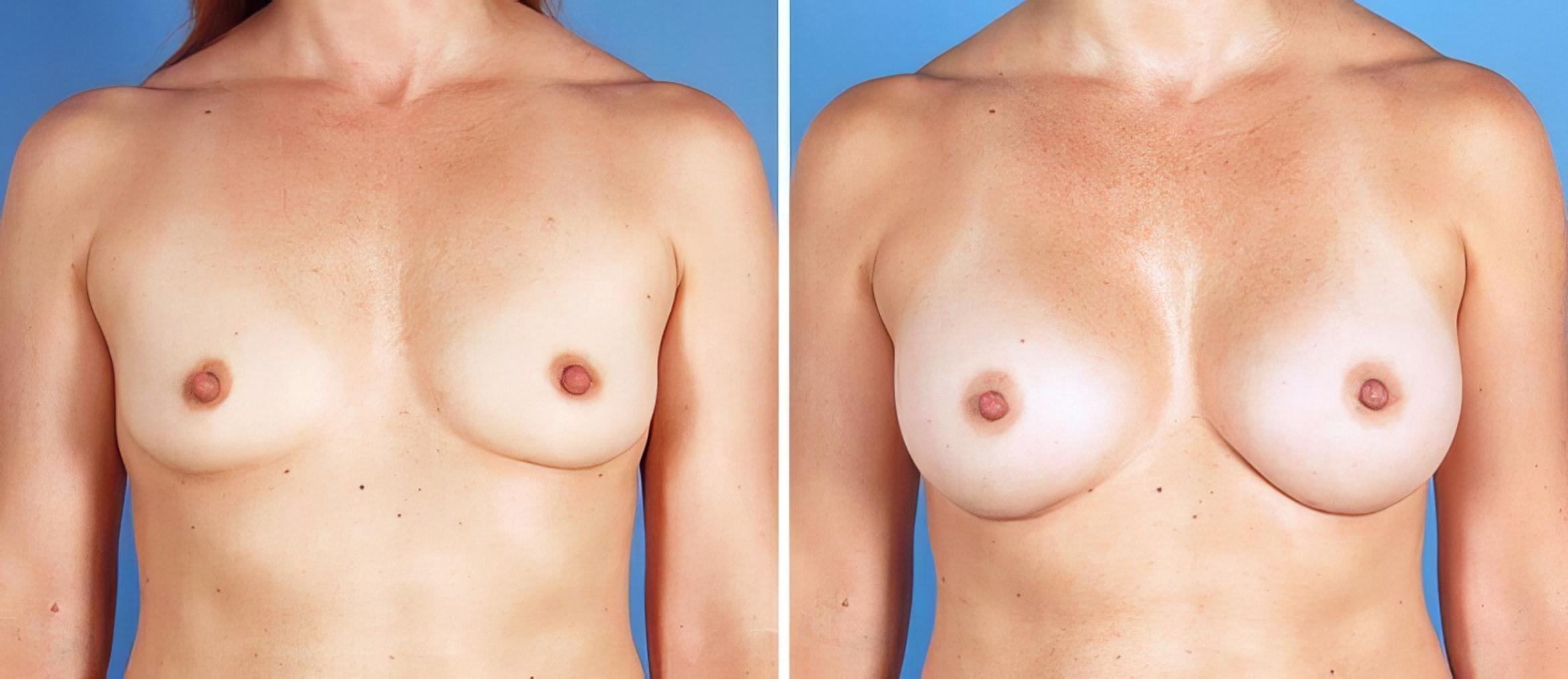 Breast Augmentation Before & After Case 25212
