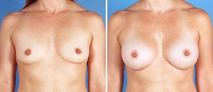 Breast Augmentation Before & After Case 25212
