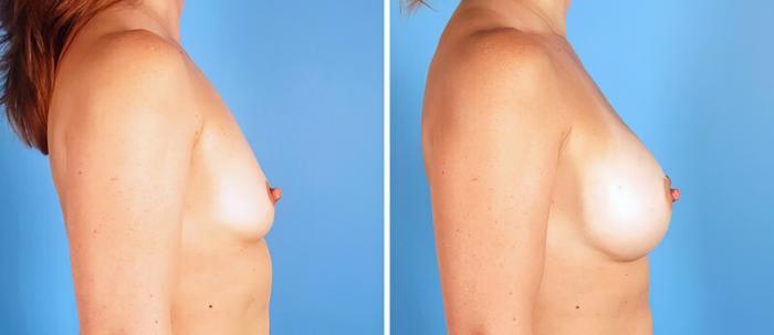Breast Augmentation Before & After Case 25212