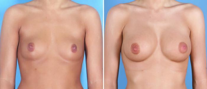Breast Augmentation Before & After Case 25219