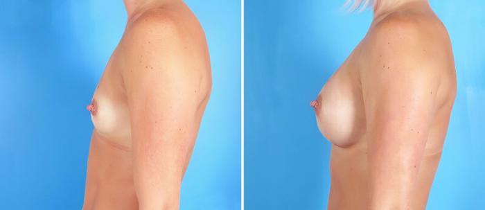 Breast Augmentation Before & After Case 25225