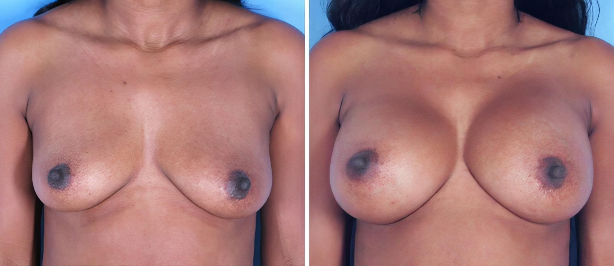 Breast Augmentation Before & After Case 25231