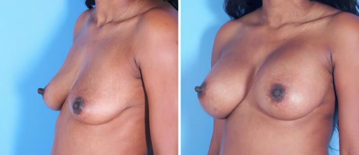 Breast Augmentation Before & After Case 25231