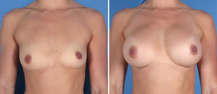 Breast Augmentation Before & After Case 25501