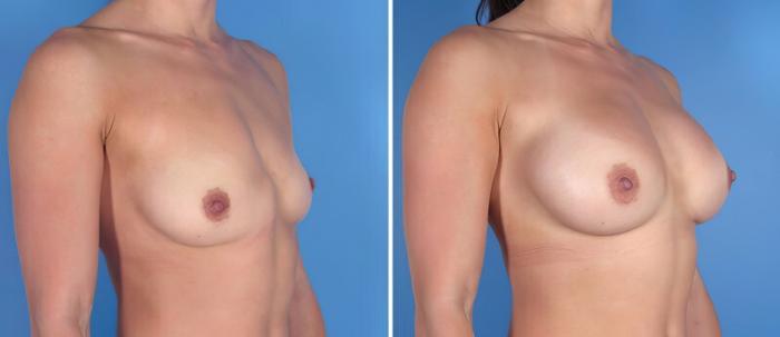 Breast Augmentation Before & After Case 25501