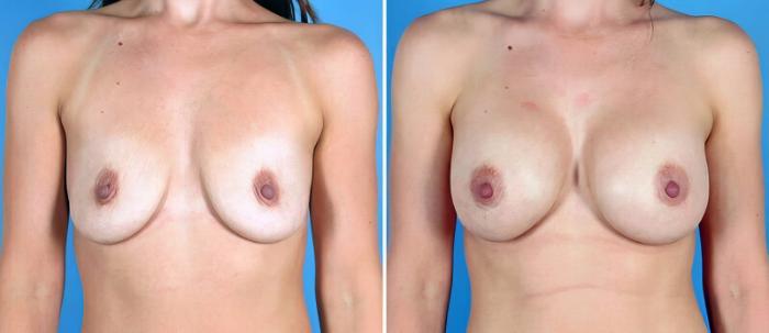 Breast Augmentation Before & After Case 25510