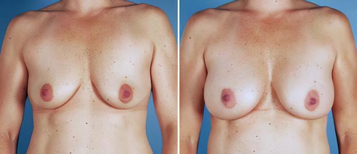 Breast Augmentation Before & After Case 25516