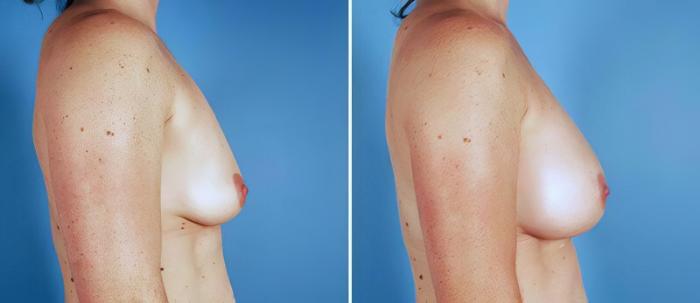 Breast Augmentation Before & After Case 25516